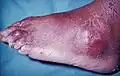 Tophii on the toe and ankle