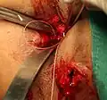 Suture close External sphincter Muscle