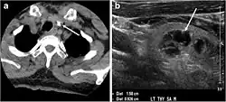 CT (L) and ultrasound (R) of thyroid colloid nodule with calcification[15][10]