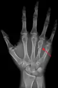 A fractured right hand fourth metacarpal (boxer's fracture).