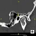 Normal ear canal